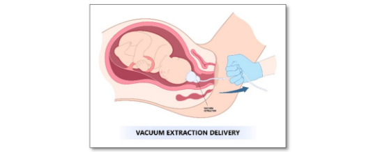 Assisted vaginal delivery