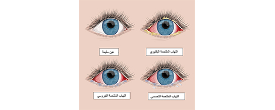 Conjunctivitis