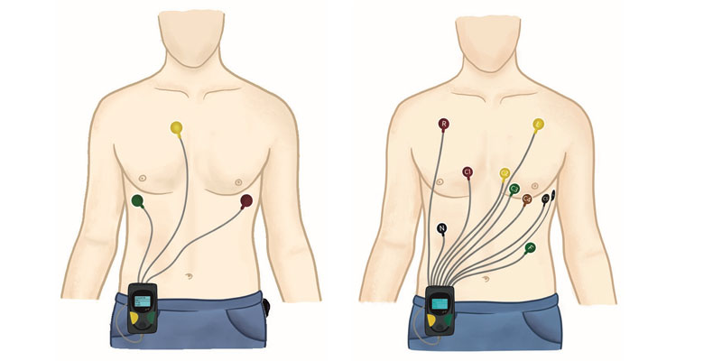 Holter Monitor