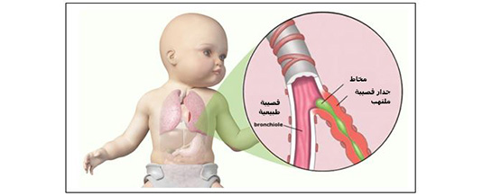 Bronchiolitis