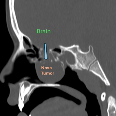 nasal