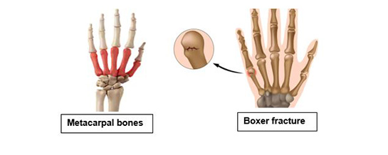 Metacarpal Fracture