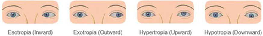 Strabismus