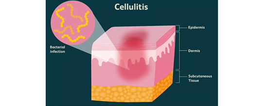 cellulitis