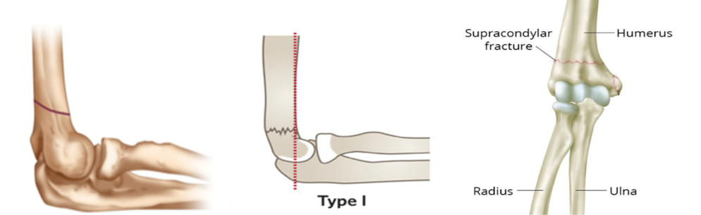 fracture image